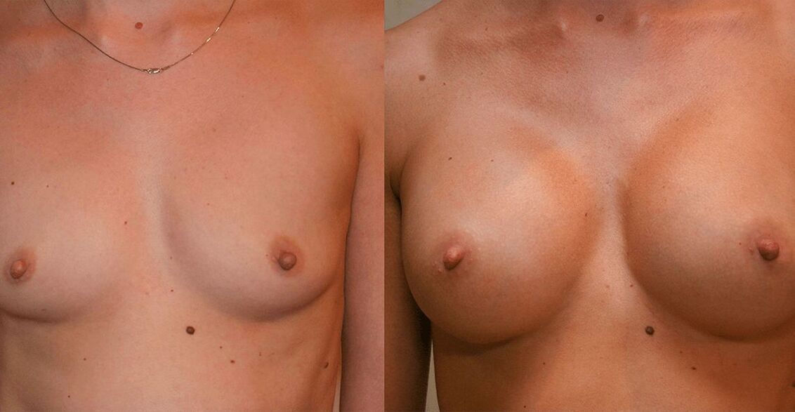 before and after breast augmentation surgery