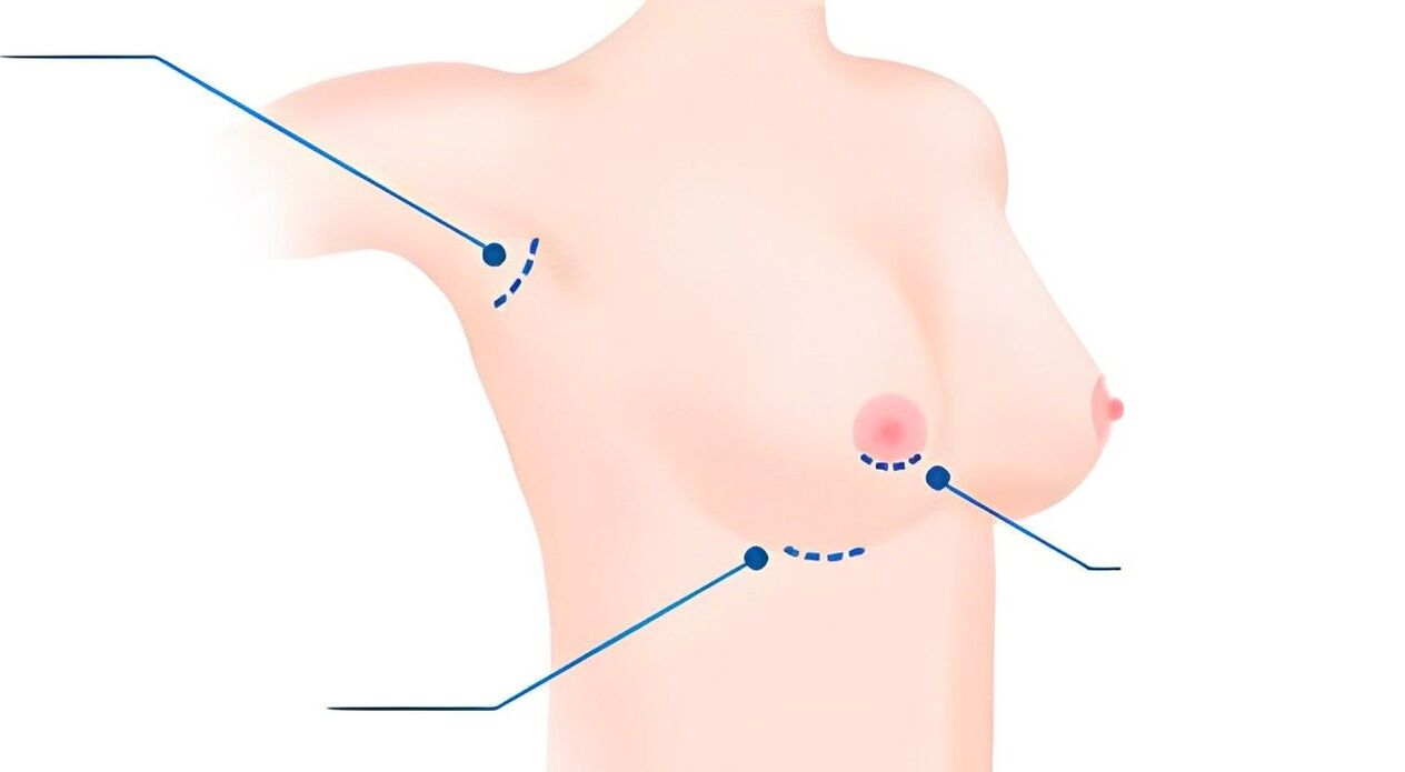 types of measurements for breast augmentation